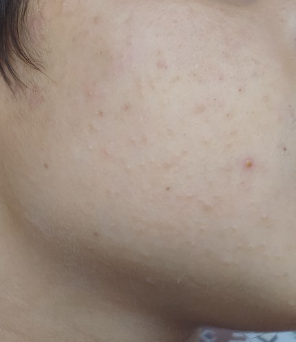 Roaccutane yan etkileri nelerdir?