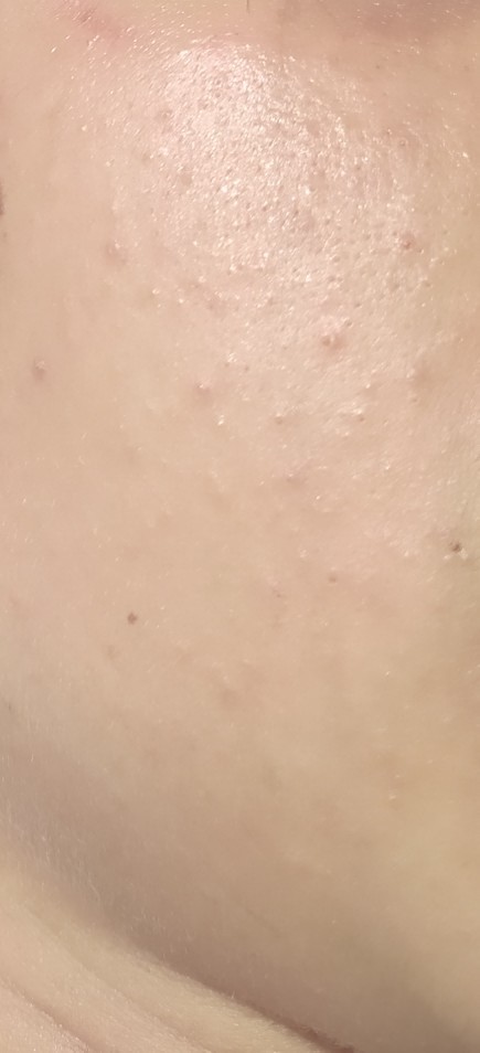 Roaccutane yan etkileri nelerdir?