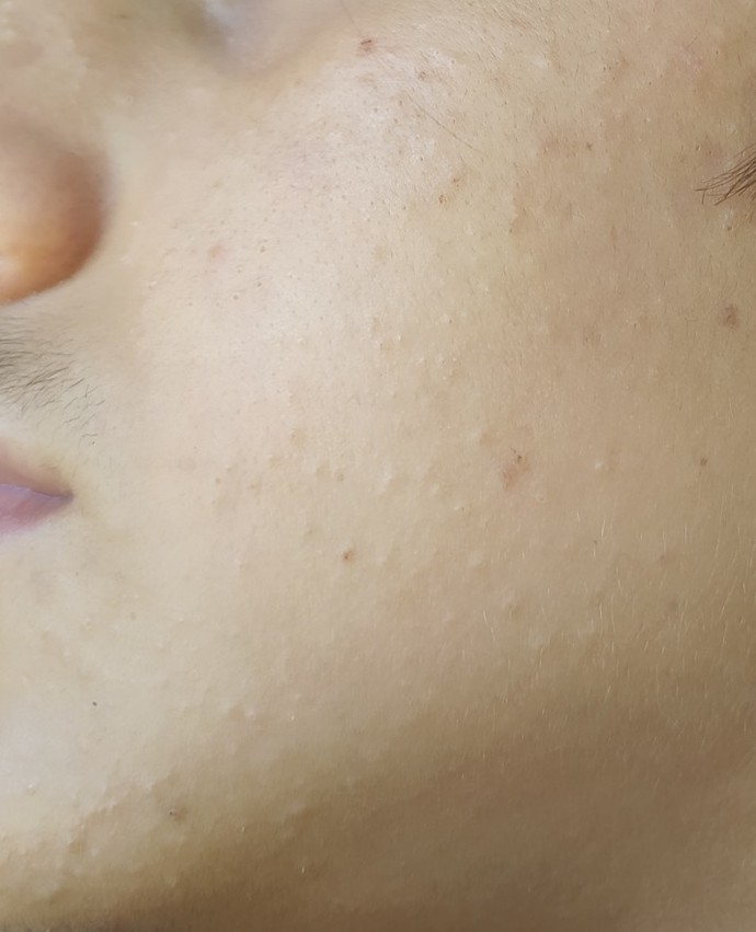 Roaccutane yan etkileri nelerdir?
