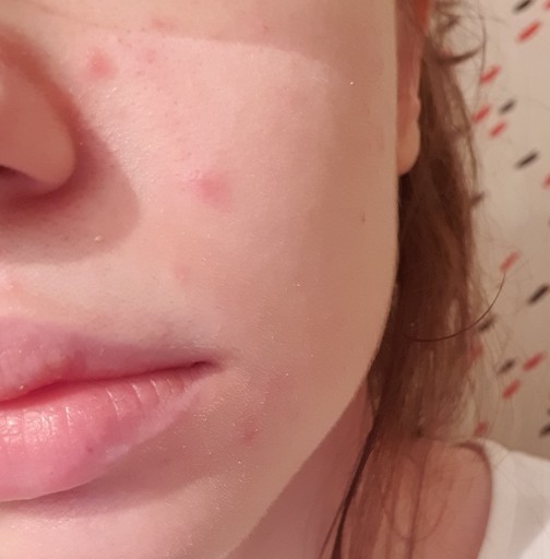 Egzama falan mı yoksa alerji mi bu, yanıyor ama kaşınmıyor?