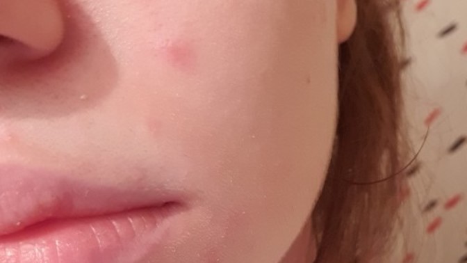 Egzama falan mı yoksa alerji mi bu, yanıyor ama kaşınmıyor?