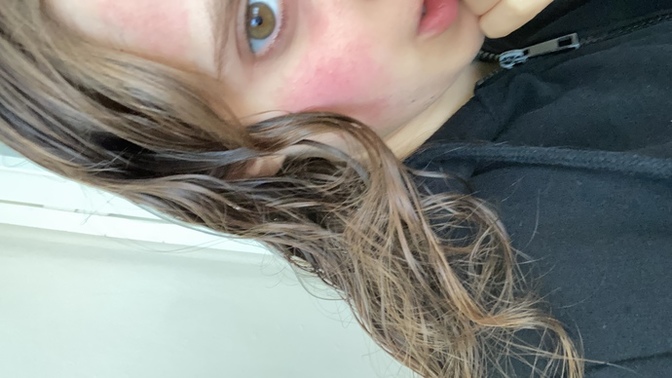 Yüzüme siyah maske yaptım, böyle kırmızı yaptı yüzümü. Ne yapmalıyım?