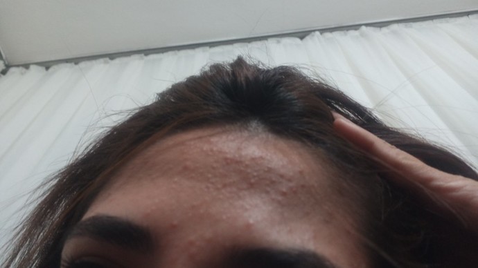 Sivilce için bunu kullanan var mı?