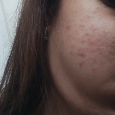Sivilce için bunu kullanan var mı?