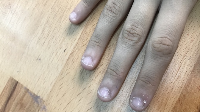 Tırnaklarımı çok yiyordum ama uzatmaya başladım hiç yemesem uzatsam kötü gözükür mü bu şekil yoksa düzelir mi tırnaklarım?