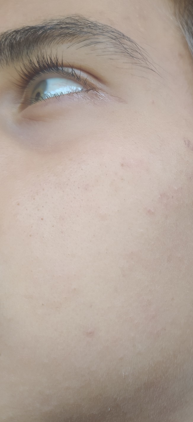 Kapalı komedon ve siyah nokta için clindoxyl kötü mü değil mi?