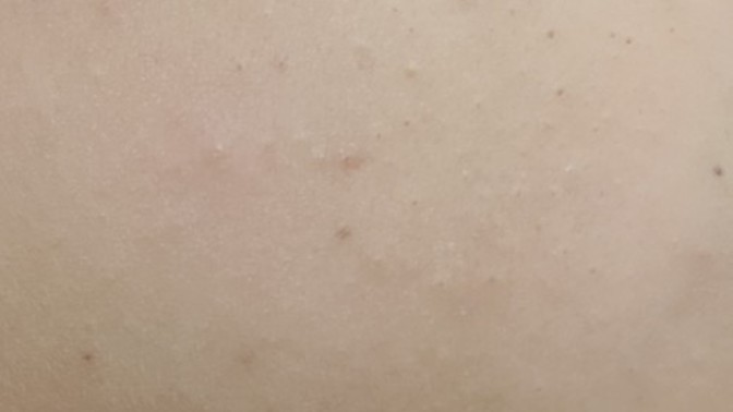 Kapalı komedon ve siyah nokta için clindoxyl kötü mü değil mi?