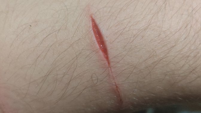 Buna dikiş gerekir mi kendiliğinden geçer mi?