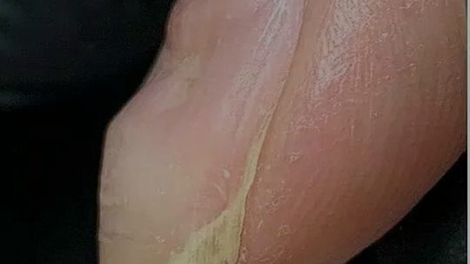 Tırnak hastalığı ile ilgili?