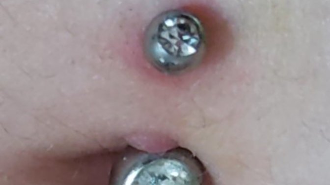 Göbek piercing i keloid?