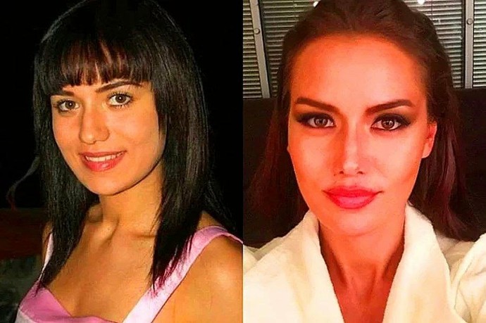 Jawline (çene dolgusu) bir estetik sayılır mı?
