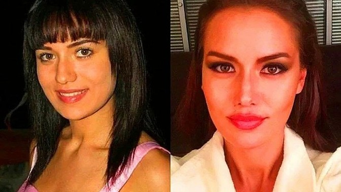 Jawline (çene dolgusu) bir estetik sayılır mı?