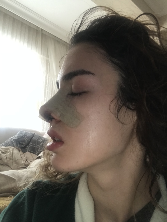 Burun estetiği burnu düşen oldu mu bu benim 2. Ameliyatım öksürük oluyor düşmesinden korkuyorum?