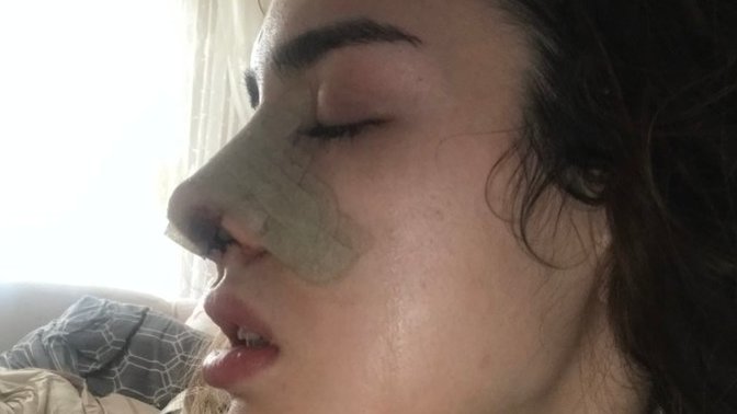 Burun estetiği burnu düşen oldu mu bu benim 2. Ameliyatım öksürük oluyor düşmesinden korkuyorum?