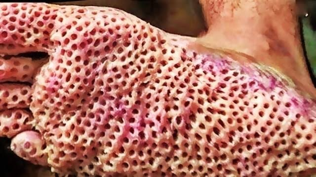 Tripofobiniz var mı?