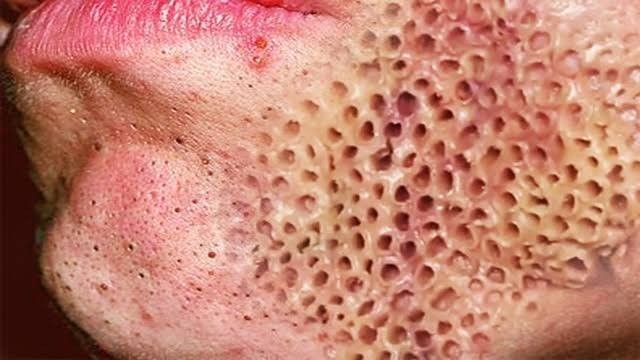 Tripofobiniz var mı?