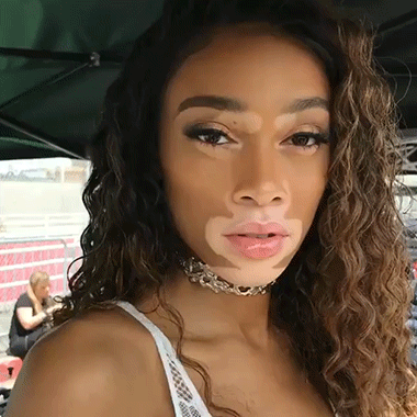 Vitiligo olan birinin çekici olması imkansız mı?