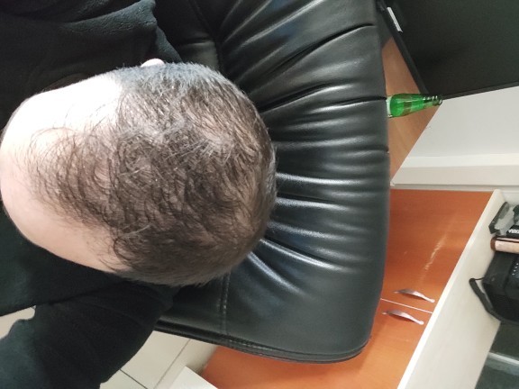 Genetik saç dökülmesi olan ve antiandrojen kullanan var mı?