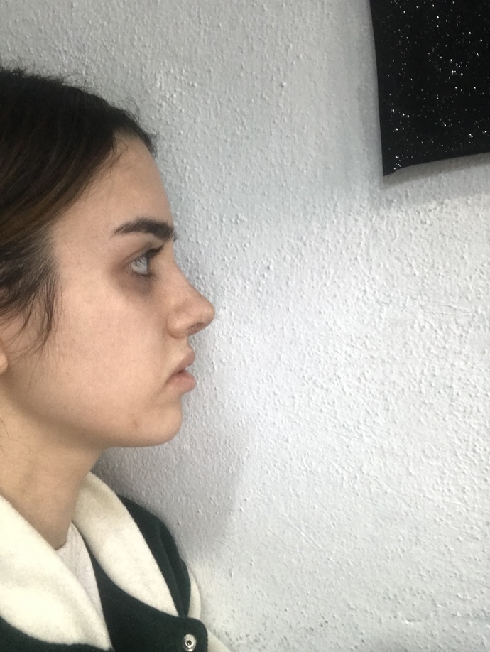 Burun estetiğim nasıl olmuş, güzel mi sizce?