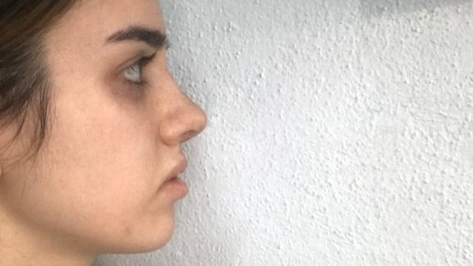 Burun estetiğim nasıl olmuş, güzel mi sizce?