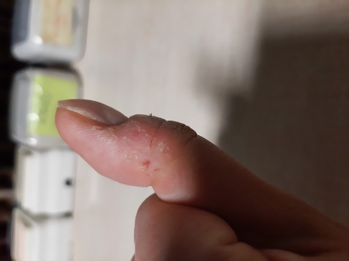 Tırnak etleri için krem önerisi verir misiniz?