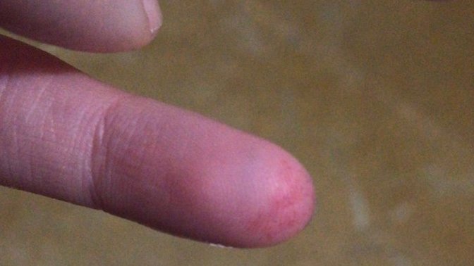 İğrenenler bakmasın!!! Parmağımı kapıya sıkıştırdım çok mu kötü? Doktora gitmeye korkuyorum?