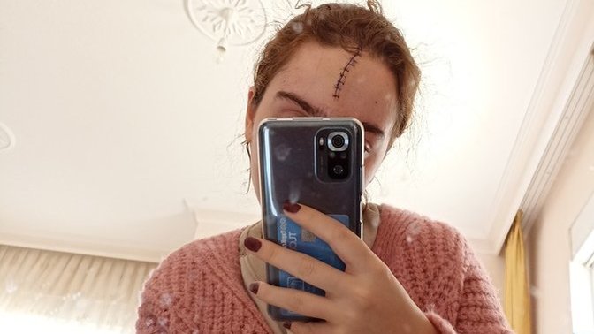 Kafamda 14 dikiş var geçer mi?