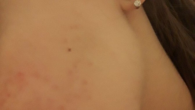 Roaccutane kullandım ve cildimde çok fazla leke kaldı. Bu lekelerin geçmesi için neler yapabilirim?