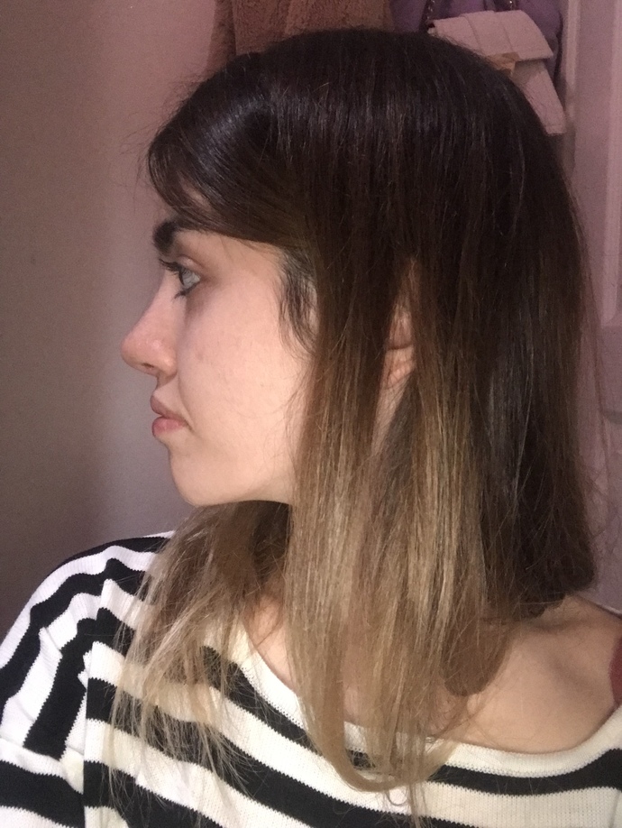 Burun estetiği 1.5 ay oldu. Sizce nasıl?