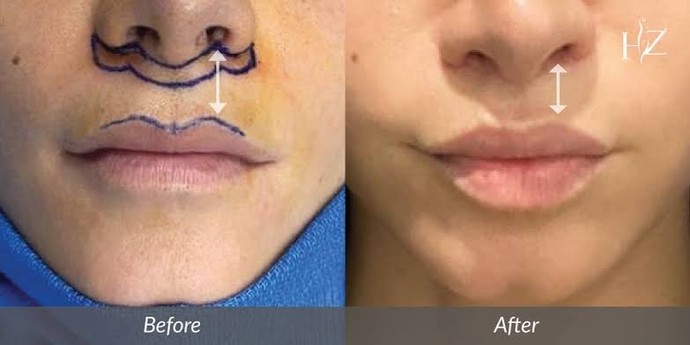 Lip lift dudak kaldırma ameliyatı yapanlar var mı, tavsiye eder misiniz?