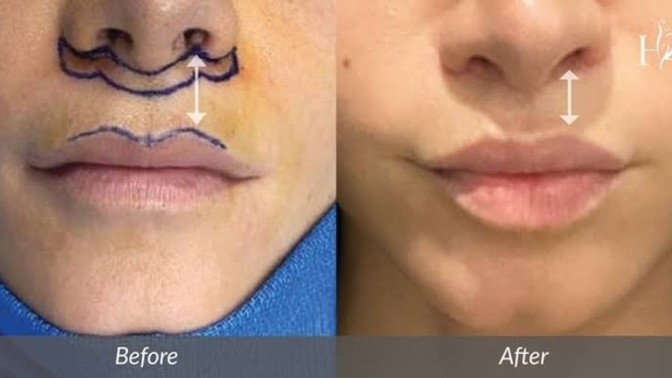 Lip lift dudak kaldırma ameliyatı yapanlar var mı, tavsiye eder misiniz?