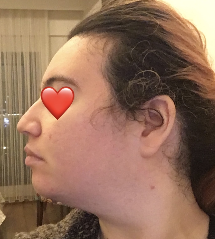 Bende çene geriliği var mı?