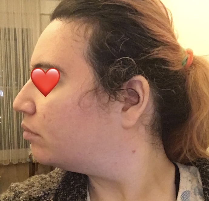 Bende çene geriliği var mı?