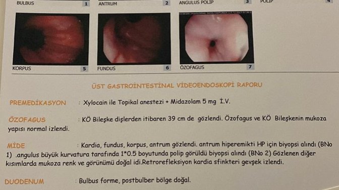 Midede polip korkulacak bir şey mi?