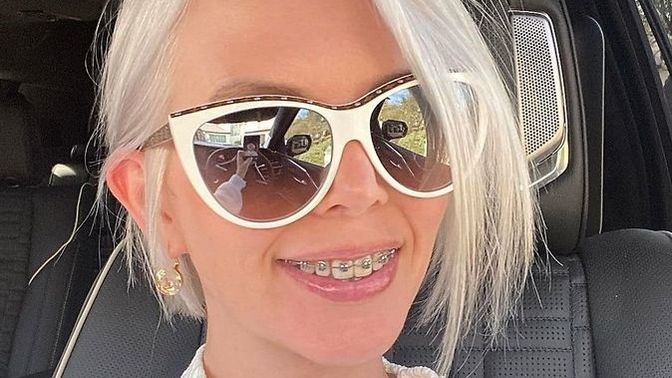 Diş telleri öpüşmeye engel midir?