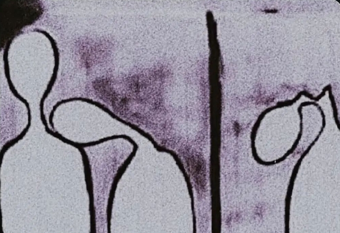 Antidepresan kullanımının artması hakkında ne düşünüyorsunuz?
