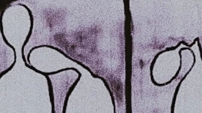 Antidepresan kullanımının artması hakkında ne düşünüyorsunuz?