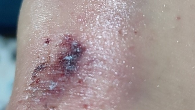 Bugün düştüm dizim şişti biraz çok mu kötü?