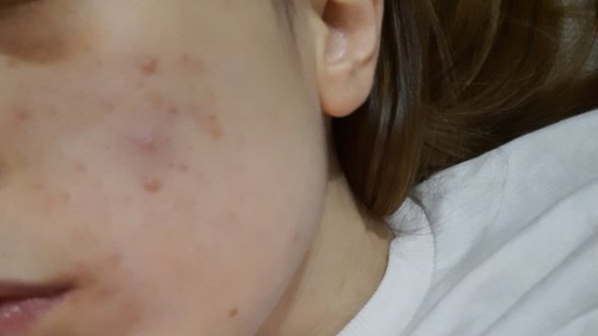 Yüzümdeki sivilce izleri geçer mi?