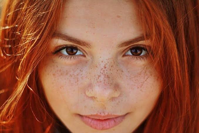 Yüzdeki çiller güzelliğe gölge düşürür mü?