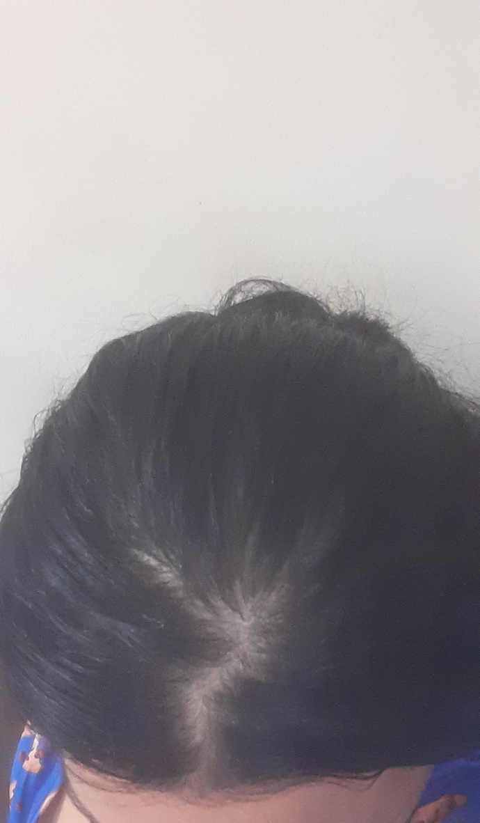 Sizce saçlarım seyrek mi, diplerinin görünmesi normal mi? Eğer seyrekse önereceğiniz bir şey var mı?