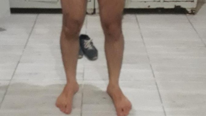 Çarpık bacak ses gelmesi?