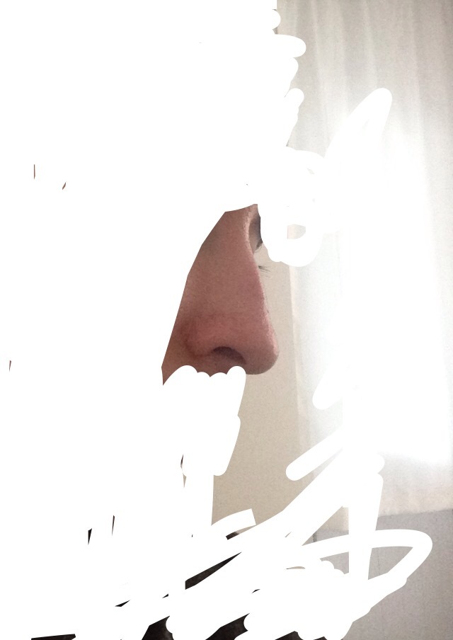 Burnum çok mu kötü estetiğe gerek var mı sizce?