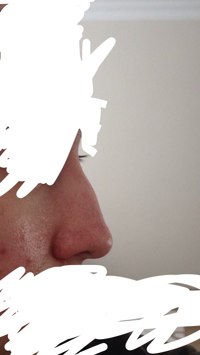 Burnum çok mu kötü estetiğe gerek var mı sizce?