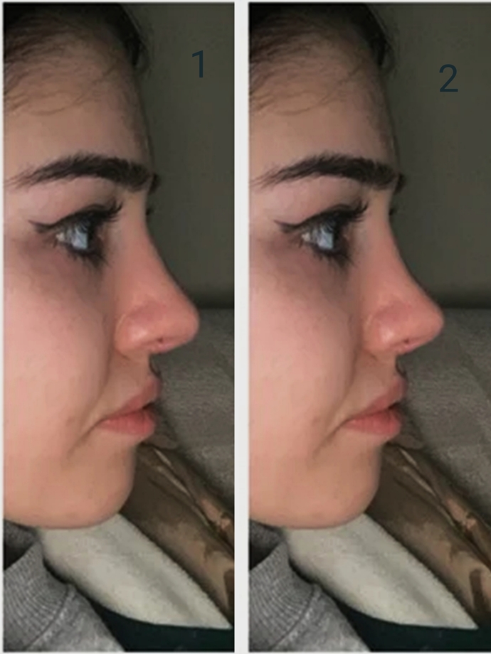 Estetik oldum ama hala burnumu beğenmiyorum. Sizce nasıl?