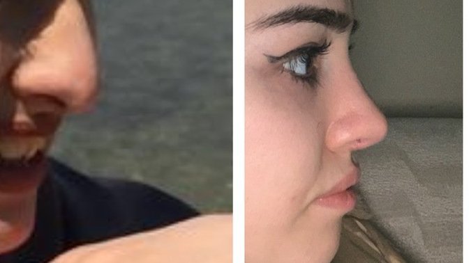 Estetik oldum ama hala burnumu beğenmiyorum. Sizce nasıl?