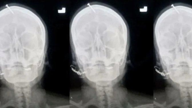 Hamile kadın erkek çocuk doğurmak için kafasına çivi çaktırmasına ne diyorsun?