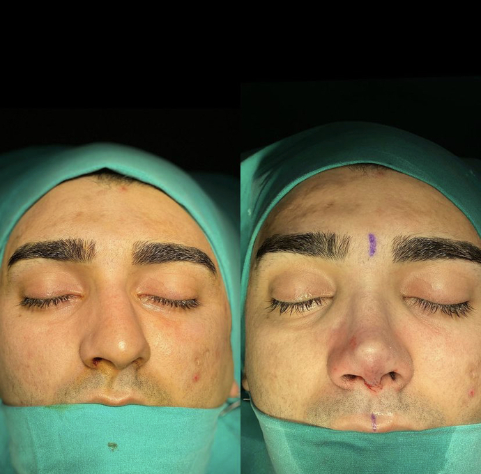 Burun estetiği oldum, sizce nasıl olmuş?