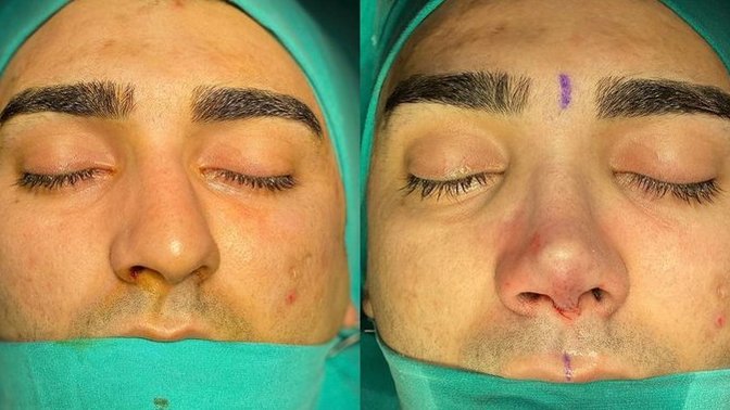 Burun estetiği oldum, sizce nasıl olmuş?