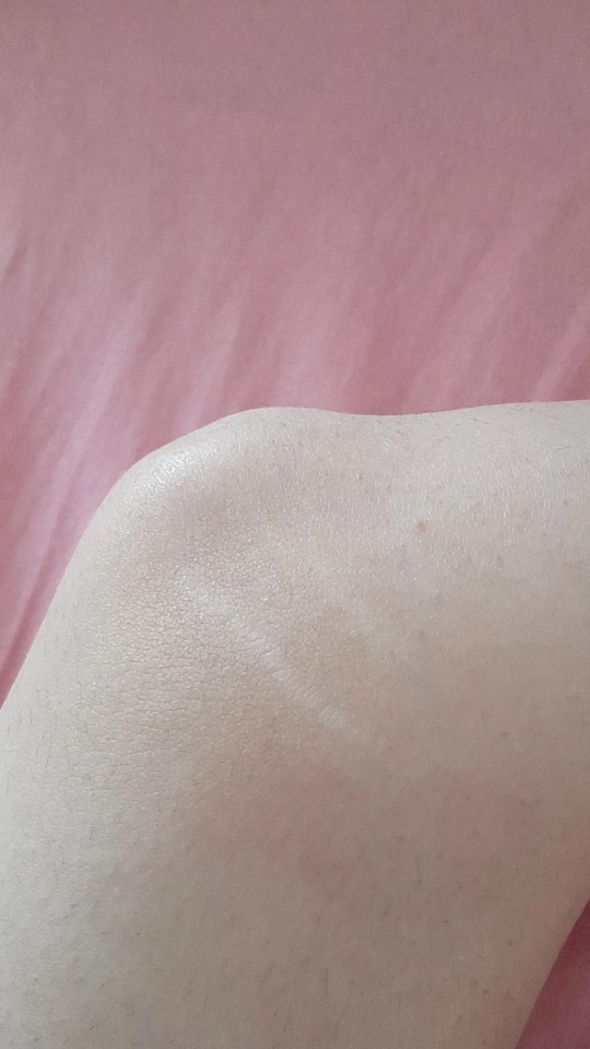 Bacaklarının her açısında böyle çatlaklar var, nasıl geçer bunlar?